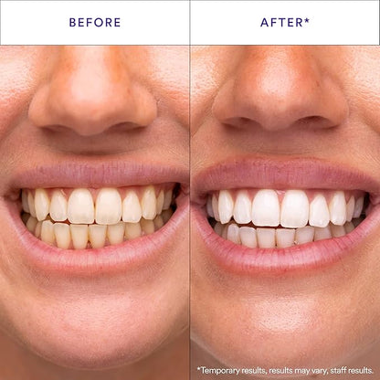 Purple Teeth Whitening Strips – Gentle Daily Purple Whitening Strips for Surface Stain Reduction & Natural Shine, Portable Whitening Strips Purple for Home or On-The-Go Use (14)