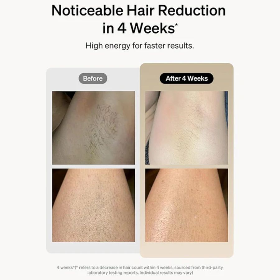 IPL Laser Hair Removal Device - 900,000 Flashes for Smooth Skin on Legs, Arms, and Bikini Line
