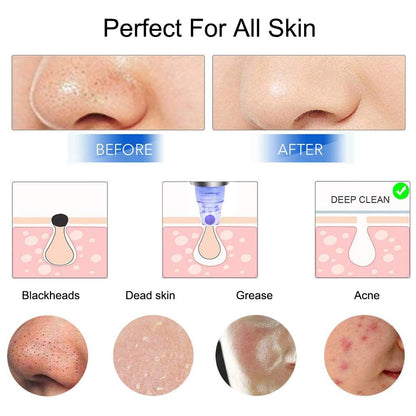 Rejuvenate Your Skin - Blackhead Remover Vacuum - Facial Pore Vacuum Extractor Electric Pore Cleaner