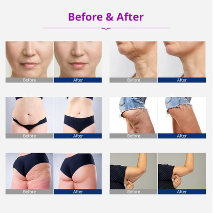 Shape Tactics 5-in-1 Cavitation RF Vacuum Body Contouring System