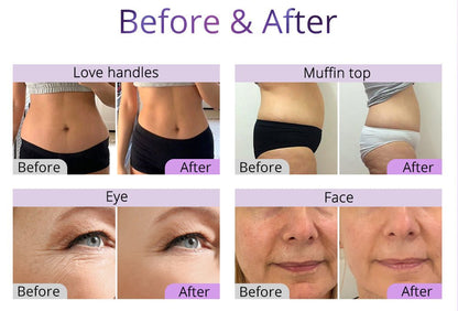 Shape Tactics 6-in-1 Ultrasonic RF Lipo Laser Contouring System