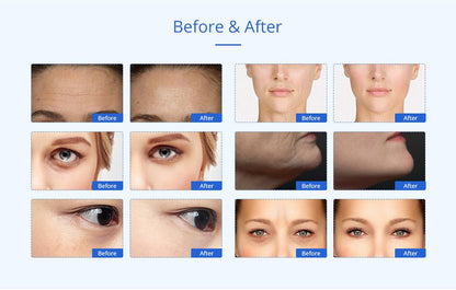 Shape Tactics Advanced 8-in-1 Unoisetion Cavitation & RF System with LED Laser Pads