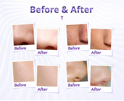 Shape Tactics Diamond Microdermabrasion & Hydrating Mist System