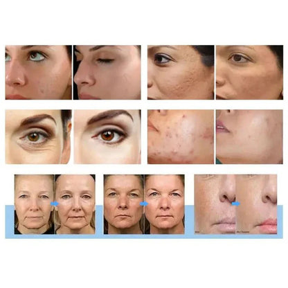 Shape Tactics Morpheus 3-in-1 Gold RF & Cold Therapy System